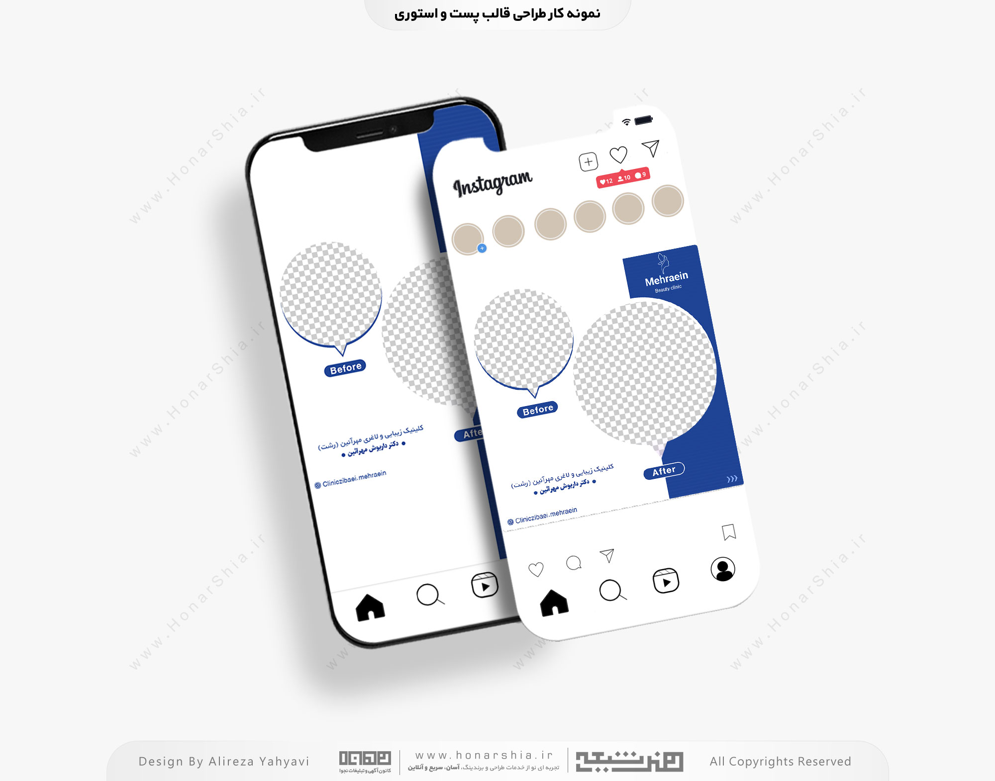 طراحی قالب پست و استوری قبل و بعد کلینیک زیبایی و لاغری مهرآئین